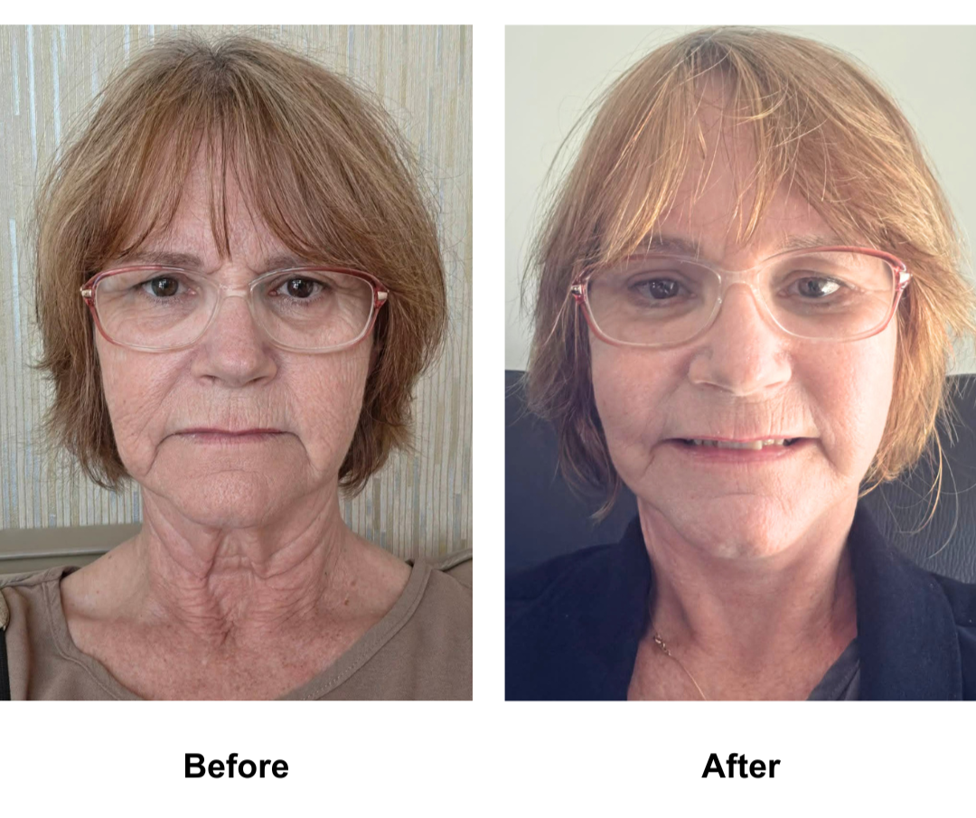 Susan had EBL + MFNL + LB + Fat trasnfer to nasolabial with Dr. Ring  (2)