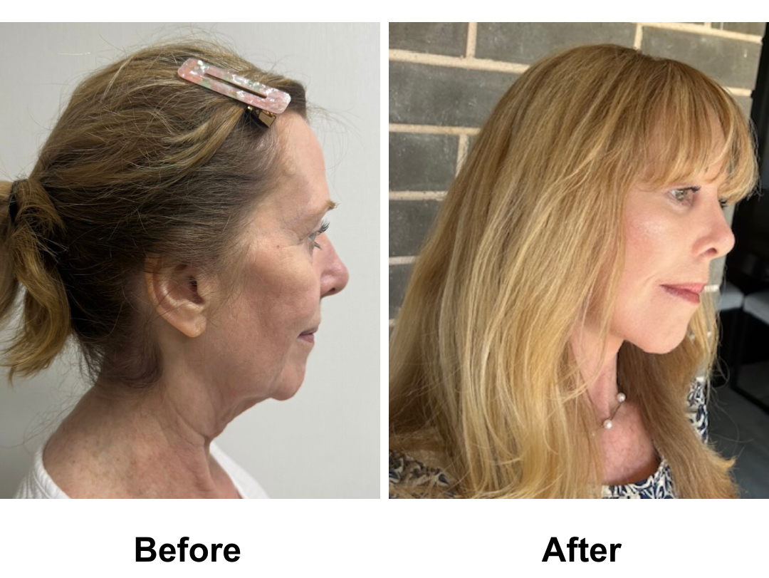 Susan had FFNL + Chin Lift + Endo Brow Lift + LB + Fat transfer 2 areas with Dr. Ring (2)