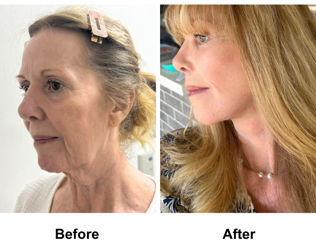 Susan had FFNL + Chin Lift + Endo Brow Lift + LB + Fat transfer 2 areas with Dr. Ring (3)