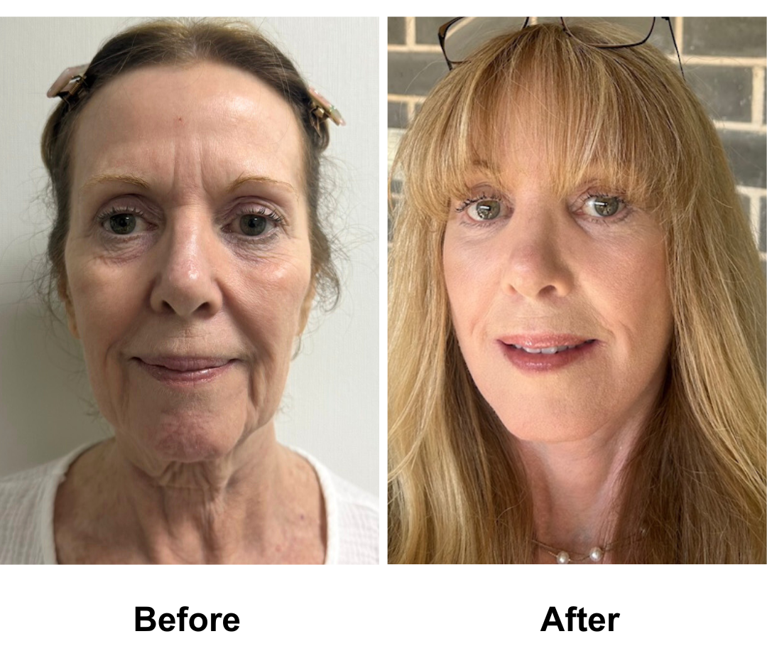 Susan had FFNL + Chin Lift + Endo Brow Lift + LB + Fat transfer 2 areas with Dr. Ring