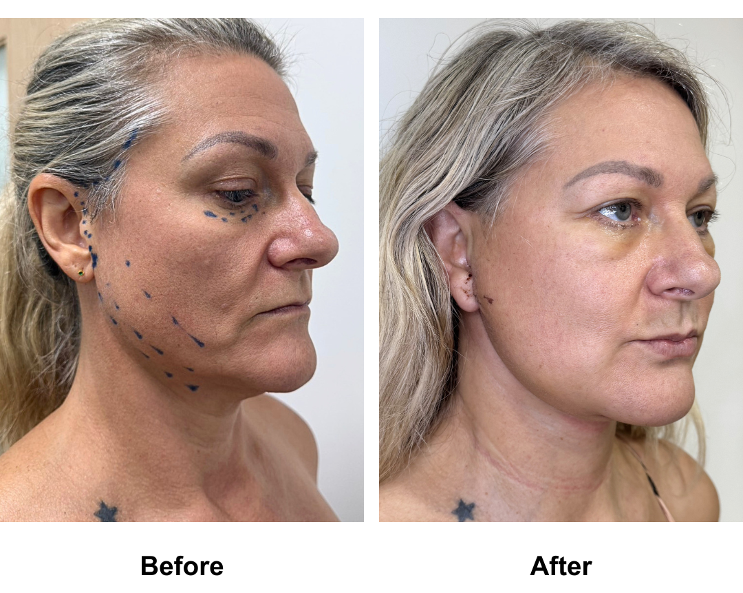 Susan had LFNL + LB + Chin Lift with Dr. Ring (1)