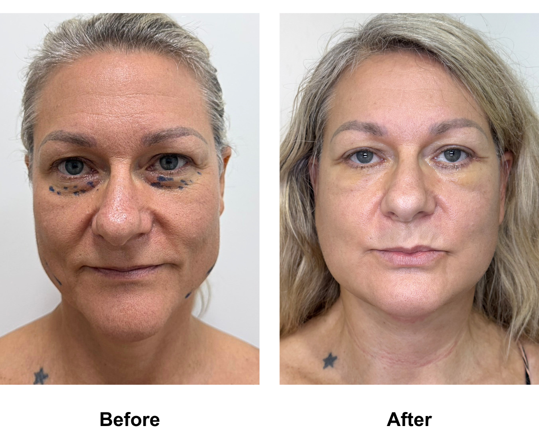Susan had LFNL + LB + Chin Lift with Dr. Ring