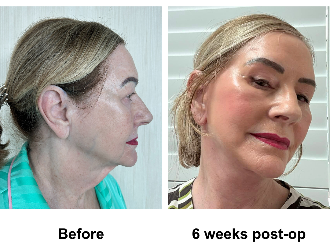Susan had MFNL + Chin lift + Sub Brow Lift + Fat transfer to face with Dr. NJ (3)