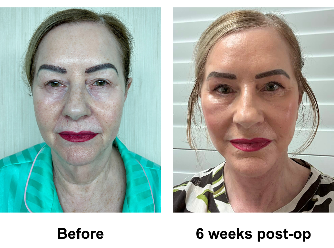 Susan had MFNL + Chin lift + Sub Brow Lift + Fat transfer to face with Dr. NJ