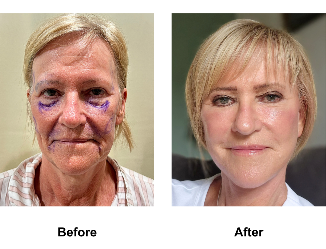 Susan had MFNL + Fat transfer to face + Sub brow lift with Dr. NJ