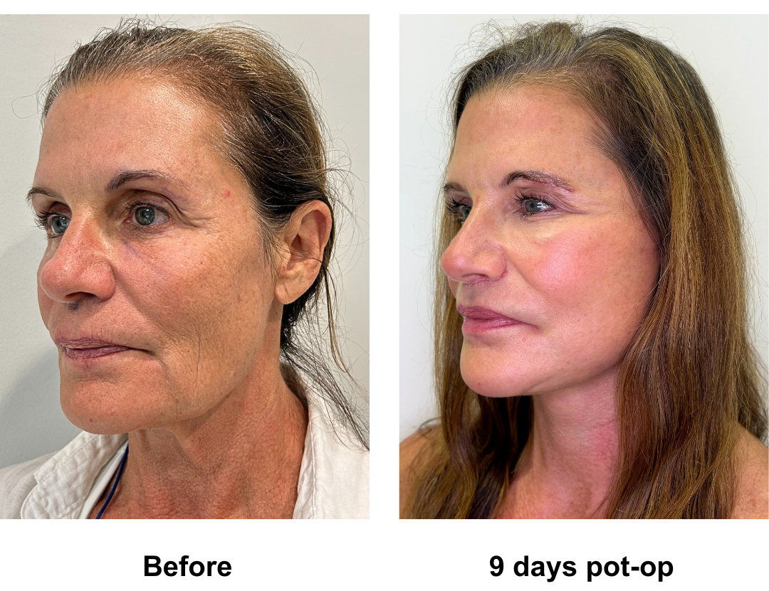 Susan had Rev. MFNL + Upper lip lift + Sub Brow Lift (2)