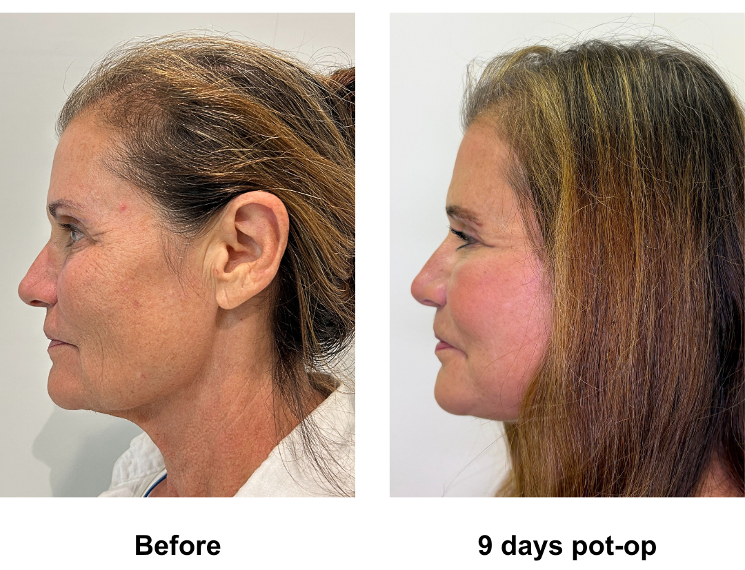 Susan had Rev. MFNL + Upper lip lift + Sub Brow Lift (3)