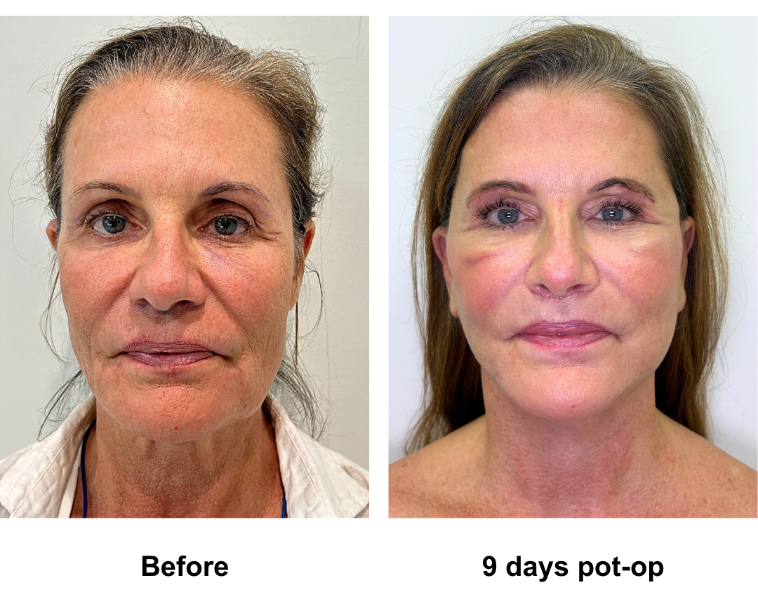 Susan had Rev. MFNL + Upper lip lift + Sub Brow Lift