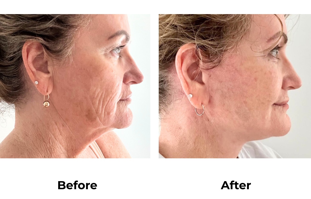Susanne had FL with Dr. NJ
