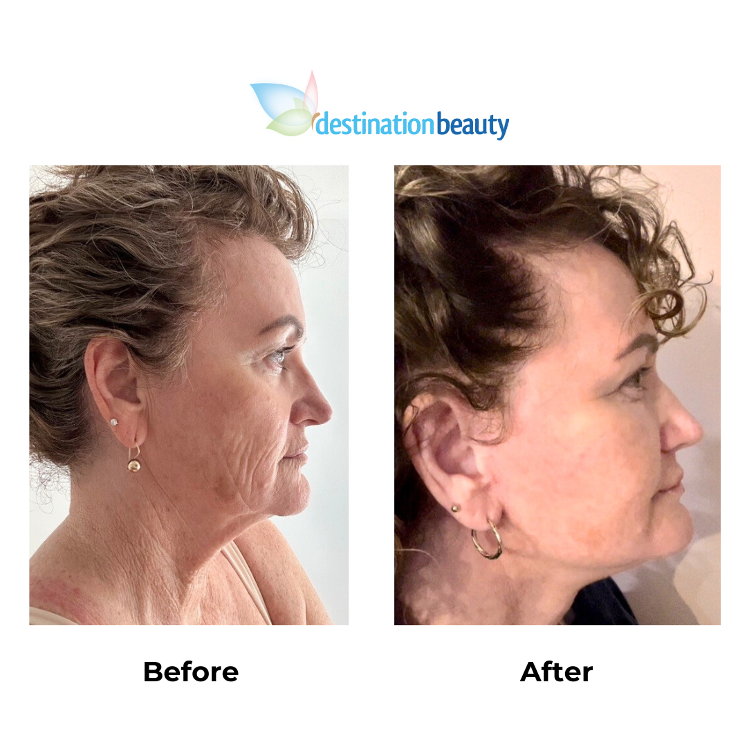 Susannes 5 months post-op facelift Thailand