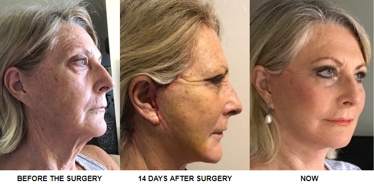 THERESA FACE LIFT POST OP UPDATES