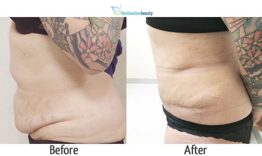 kim Tummy Tuck and lipo 