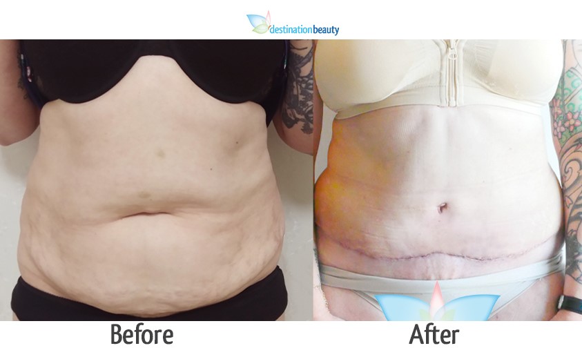 kim Tummy Tuck and lipo 