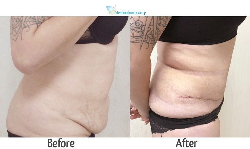 kim Tummy Tuck and lipo 