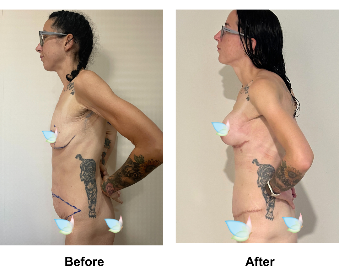 Tahnee had BABL + ExTT + Mons lift + VASER lipo 1 are on upper abs + AL with Dr. Weerachai (1)