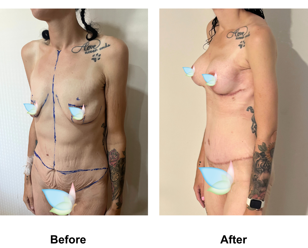 Tahnee had BABL + ExTT + Mons lift + VASER lipo 1 are on upper abs + AL with Dr. Weerachai (2)
