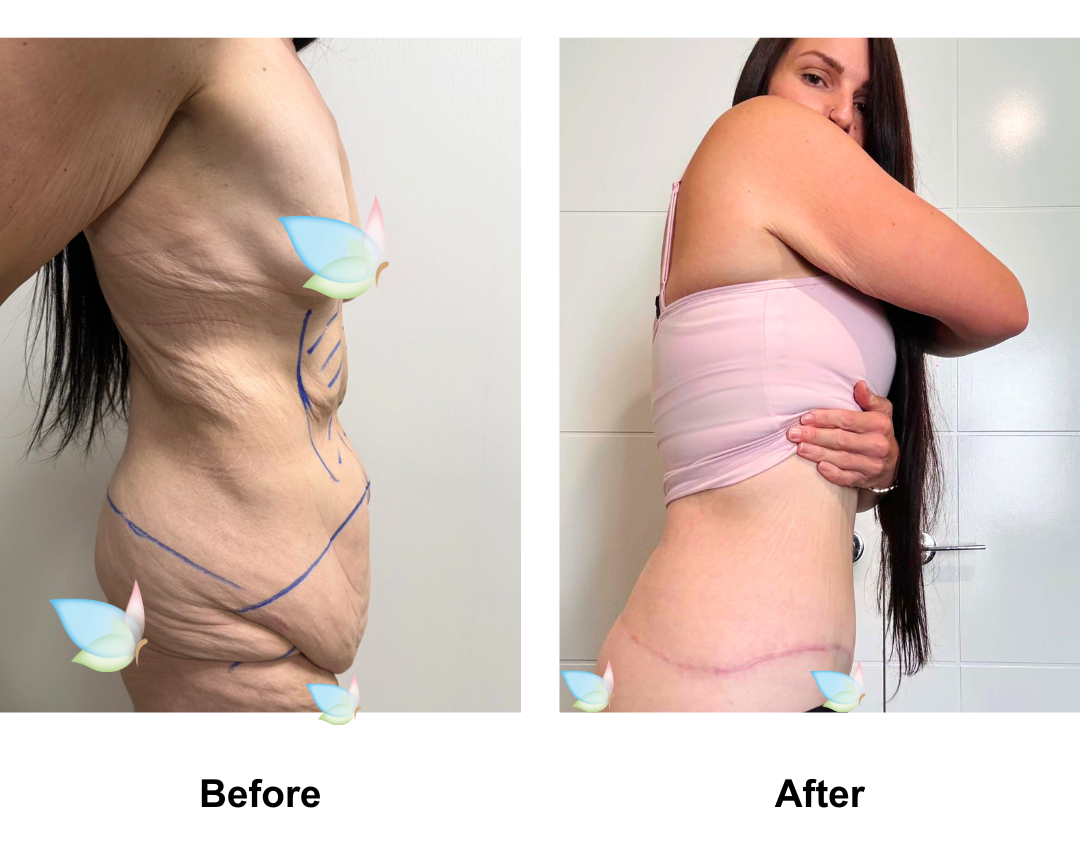 Talia had Circum TT + Lipo upper ab + Mons Lift with Dr. Ring  (1)