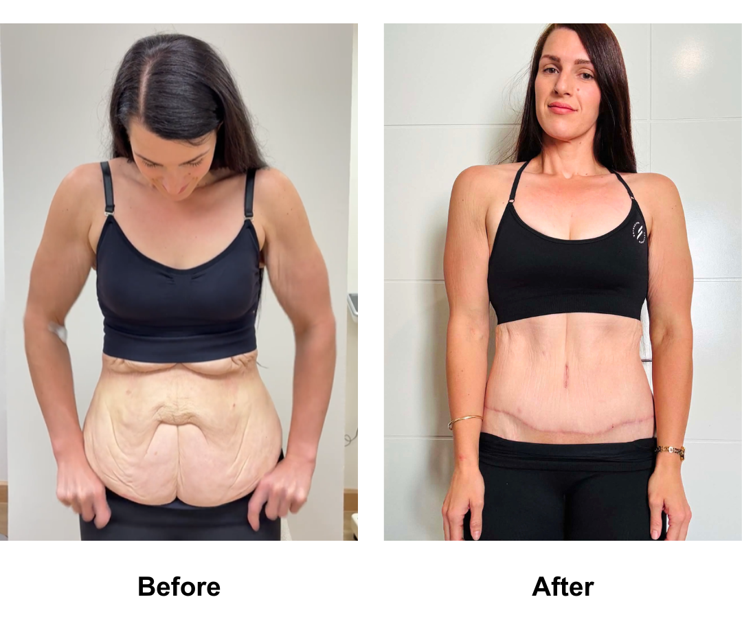 Talia had Circum TT + Lipo upper ab + Mons Lift with Dr. Ring