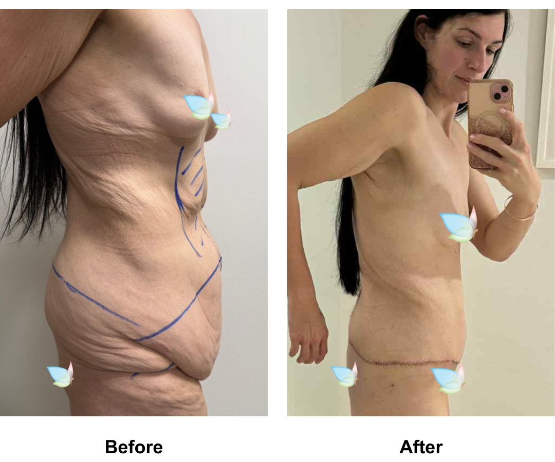 Talia had Circum TT + Vaser lipo on upper abs + Mons lift with Dr. Ring (2)