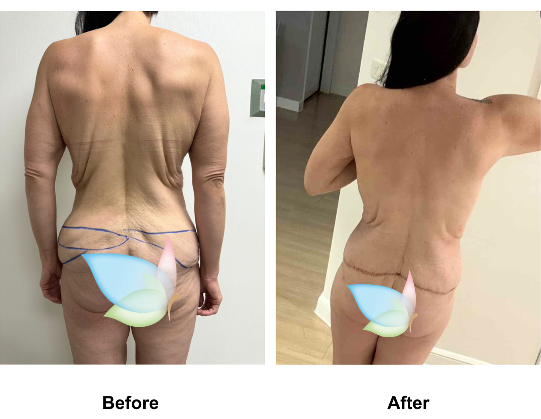 Talia had Circum TT + Vaser lipo on upper abs + Mons lift with Dr. Ring (3)