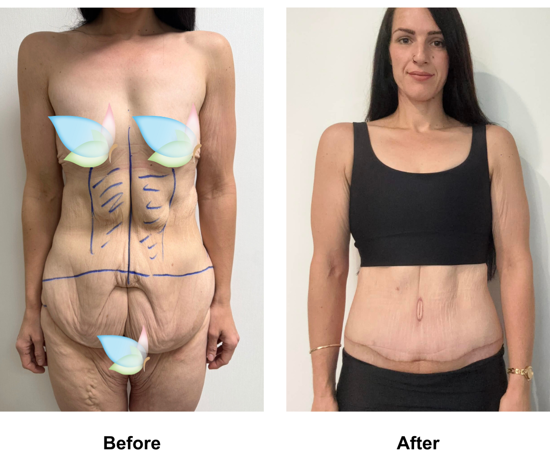 Talia had Circum TT + Vaser lipo on upper abs + Mons lift with Dr. Ring (4)