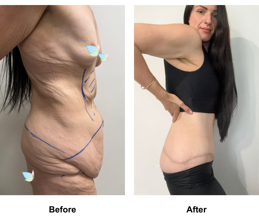 Talia had Circum TT + Vaser lipo on upper abs + Mons lift with Dr. Ring (5)
