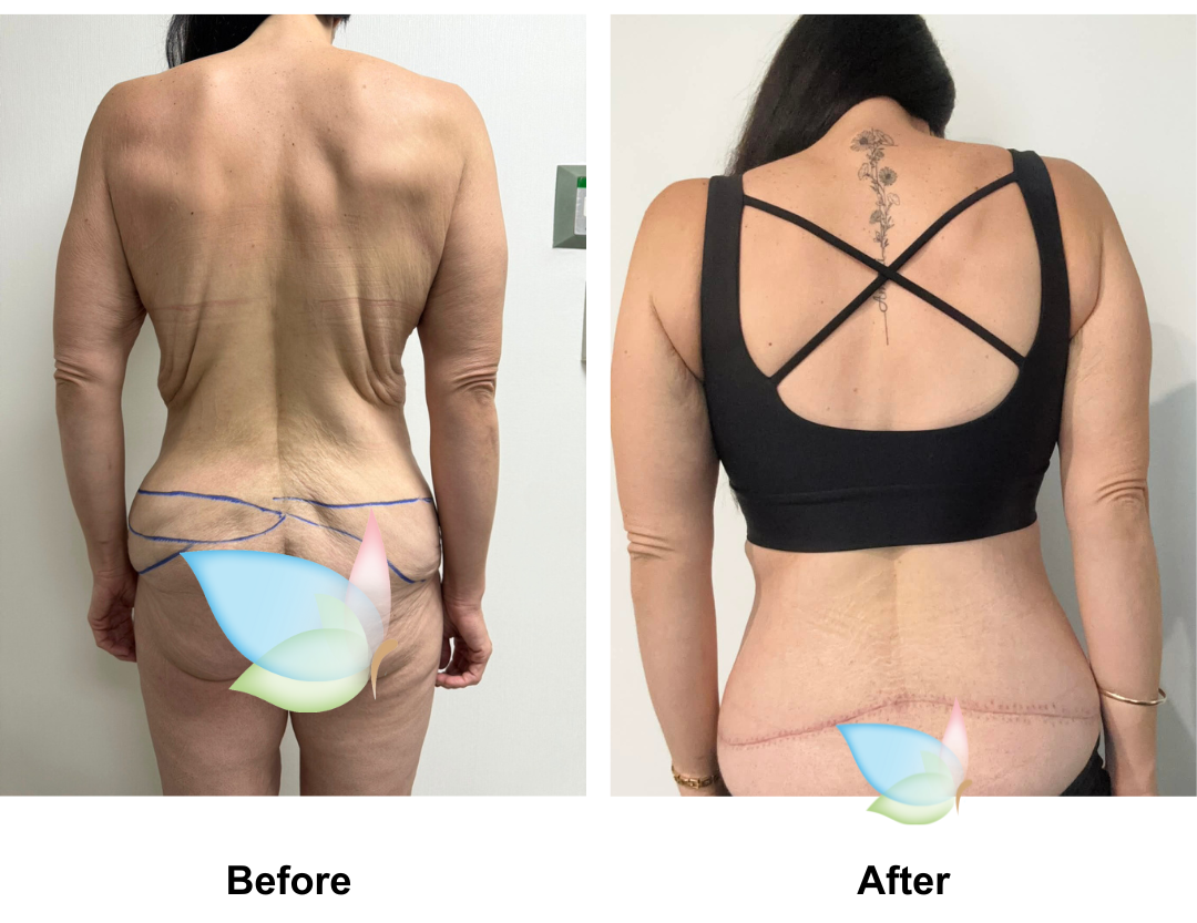 Talia had Circum TT + Vaser lipo on upper abs + Mons lift with Dr. Ring (6)
