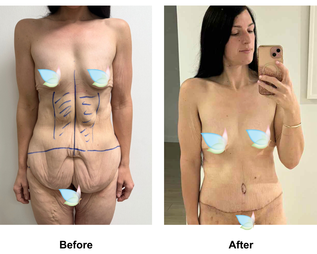 Talia had Circum TT + Vaser lipo on upper abs + Mons lift with Dr. Ring
