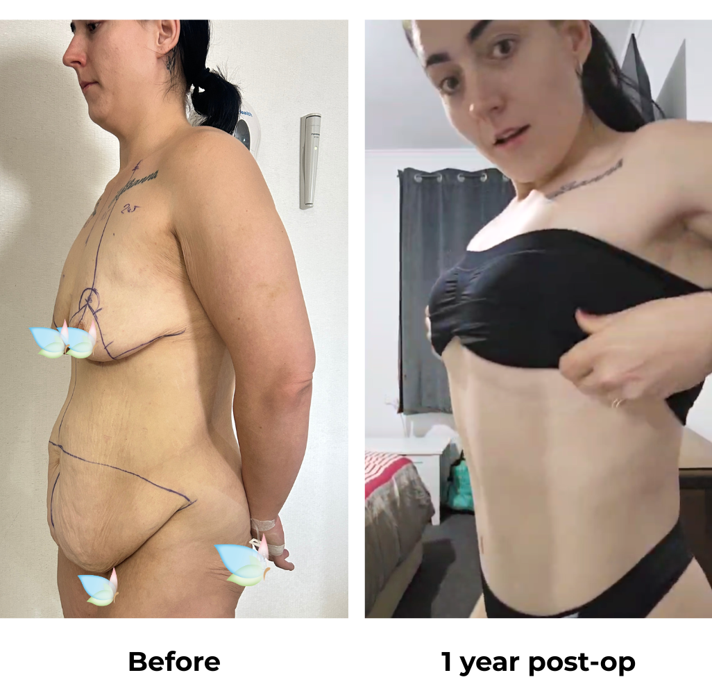 Tamara 1 year post-op (1)
