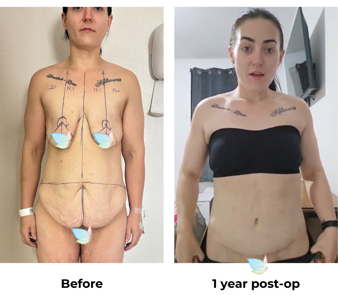 Tamara 1 year post-op 2