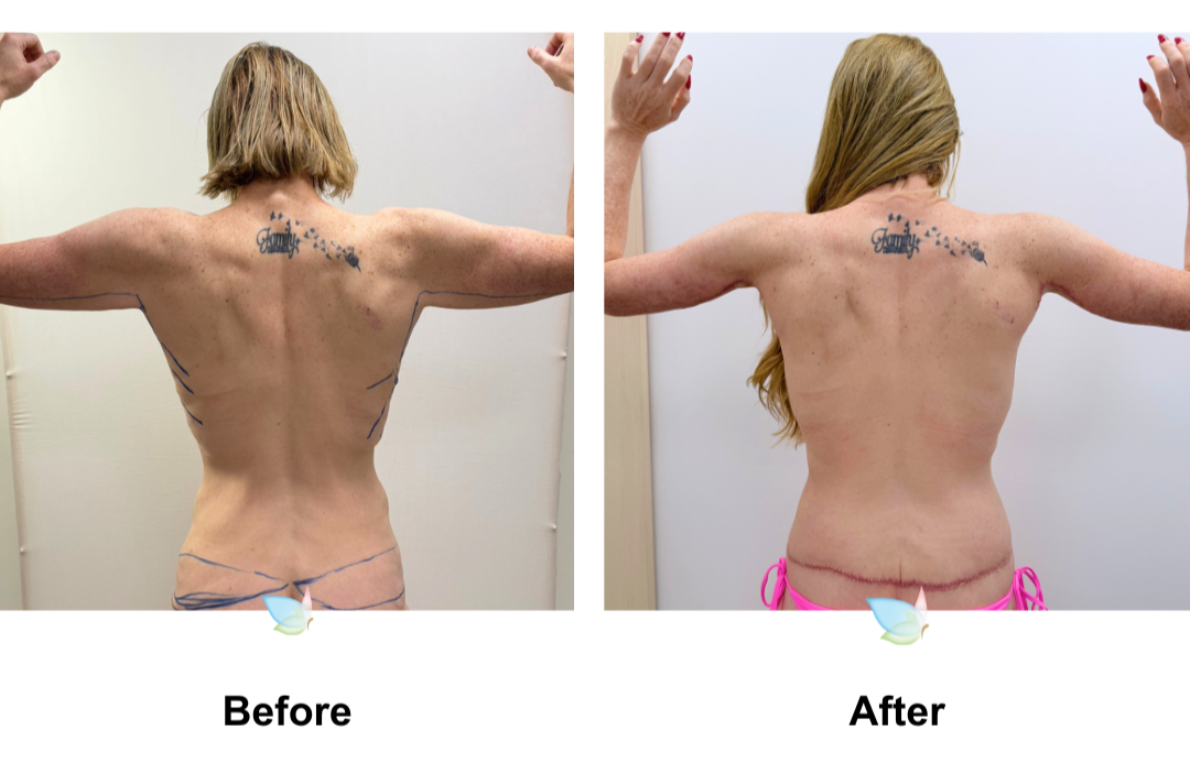 Tamara had BABL + CircumTT + Mons lift  + Back side lift + AL with Dr. Ring (1)