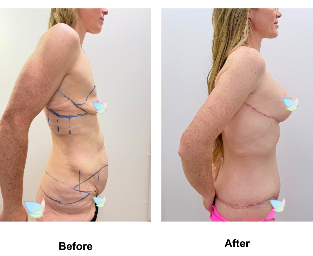 Tamara had BABL + CircumTT + Mons lift  + Back side lift + AL with Dr. Ring (2)