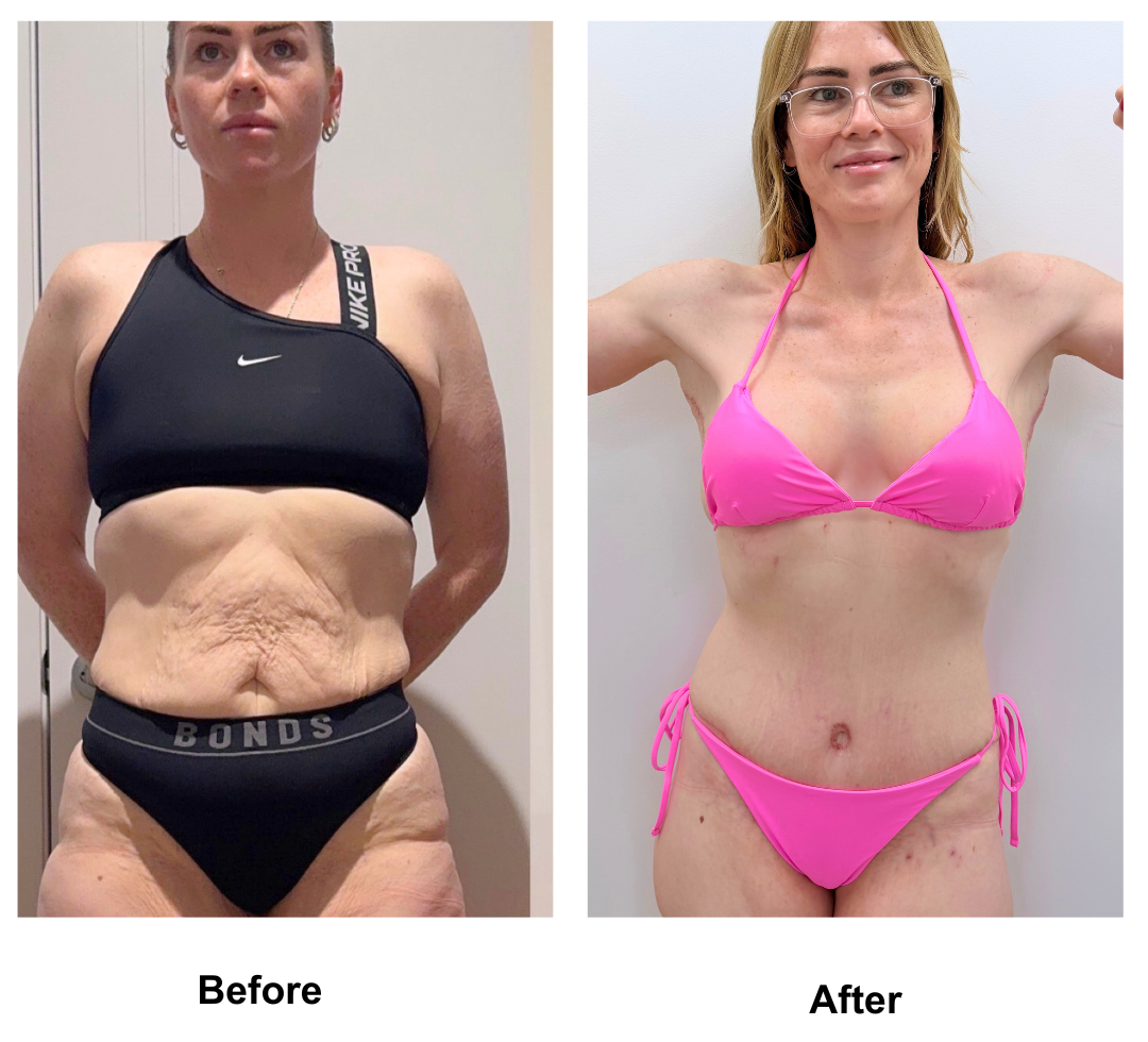 Tamara had BABL + CircumTT + Mons lift  + Back side lift + AL with Dr. Ring (3)