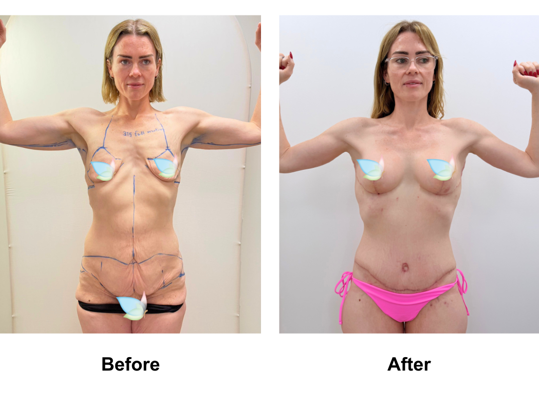 Tamara had BABL + CircumTT + Mons lift  + Back side lift + AL with Dr. Ring
