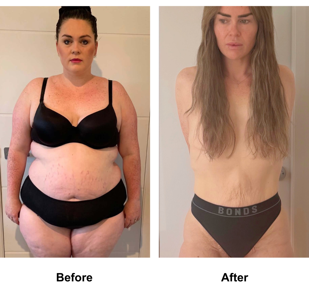 Tamara lost 75 kg after gastric sleeve