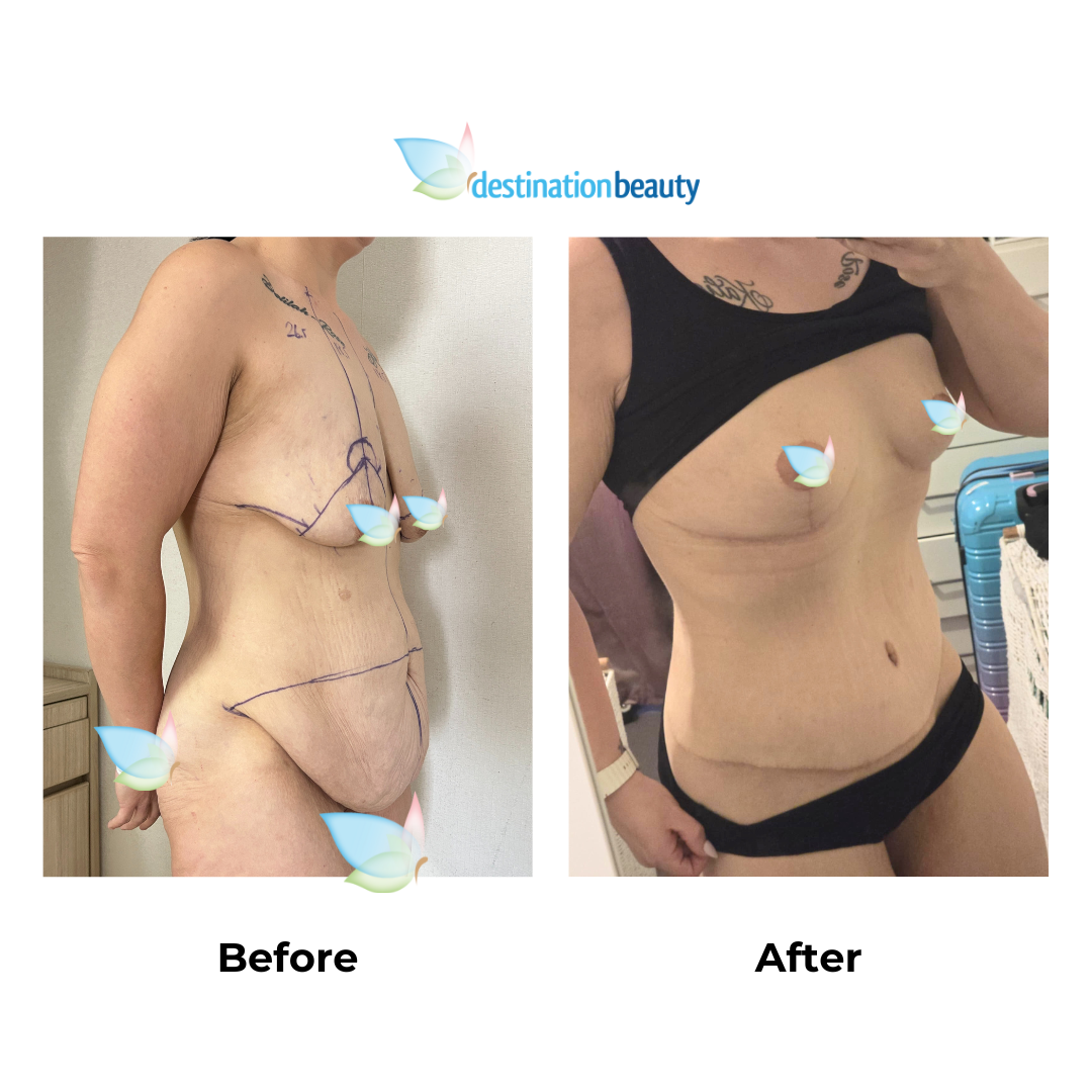 Tamaras breast lift and extended tummy tuck - 6 weeks PO (1)