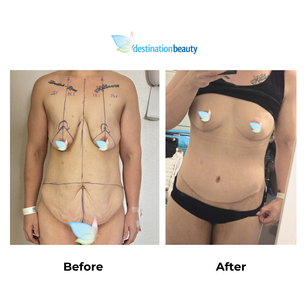 Tamaras breast lift and extended tummy tuck - 6 weeks PO