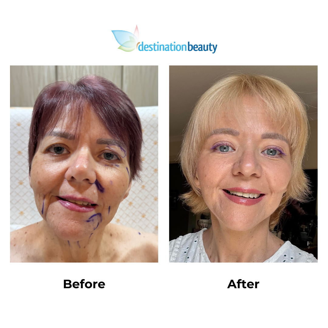 Tania had facelift with Dr. NJ 2