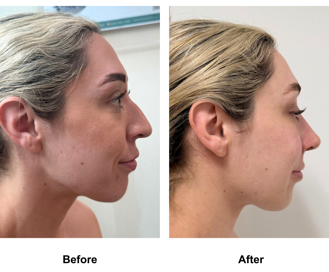 Tanika had nose reshaping with Dr. Weerakarn (1)