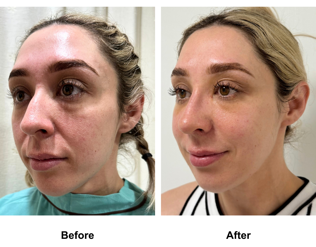 Tanika had nose reshaping with Dr. Weerakarn