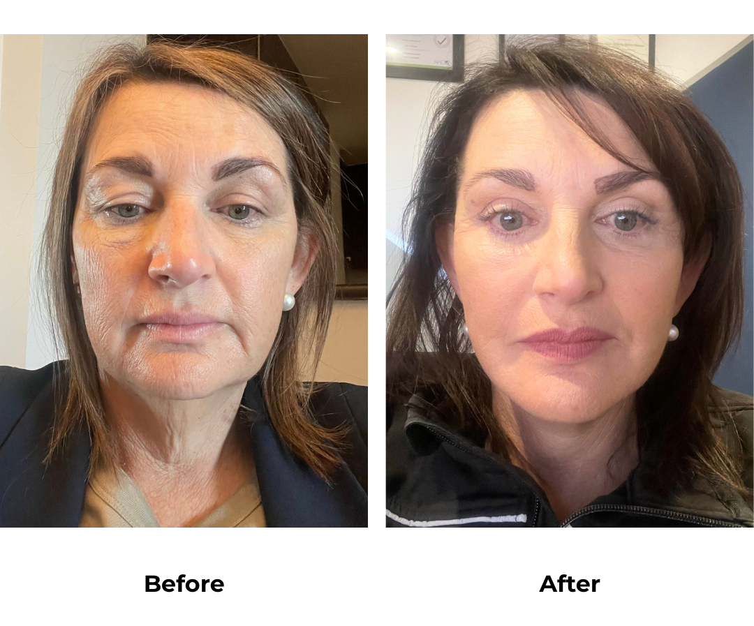 Tanya had MFNL & Upper eyelid with Dr. Ring - 7 months