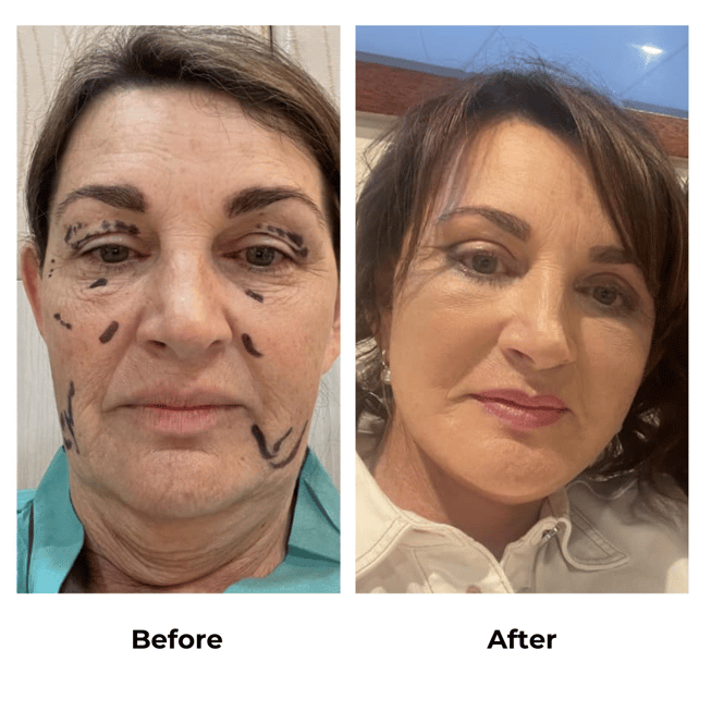 Tanya had facelift with Dr. Ring