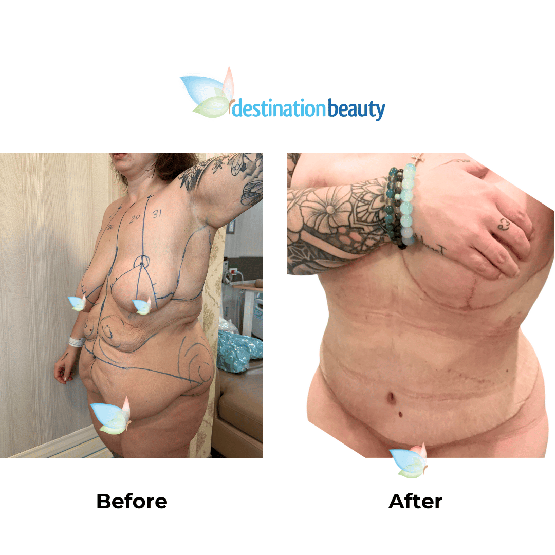 Taylahs 6 weeks post-skin removal surgery (2)