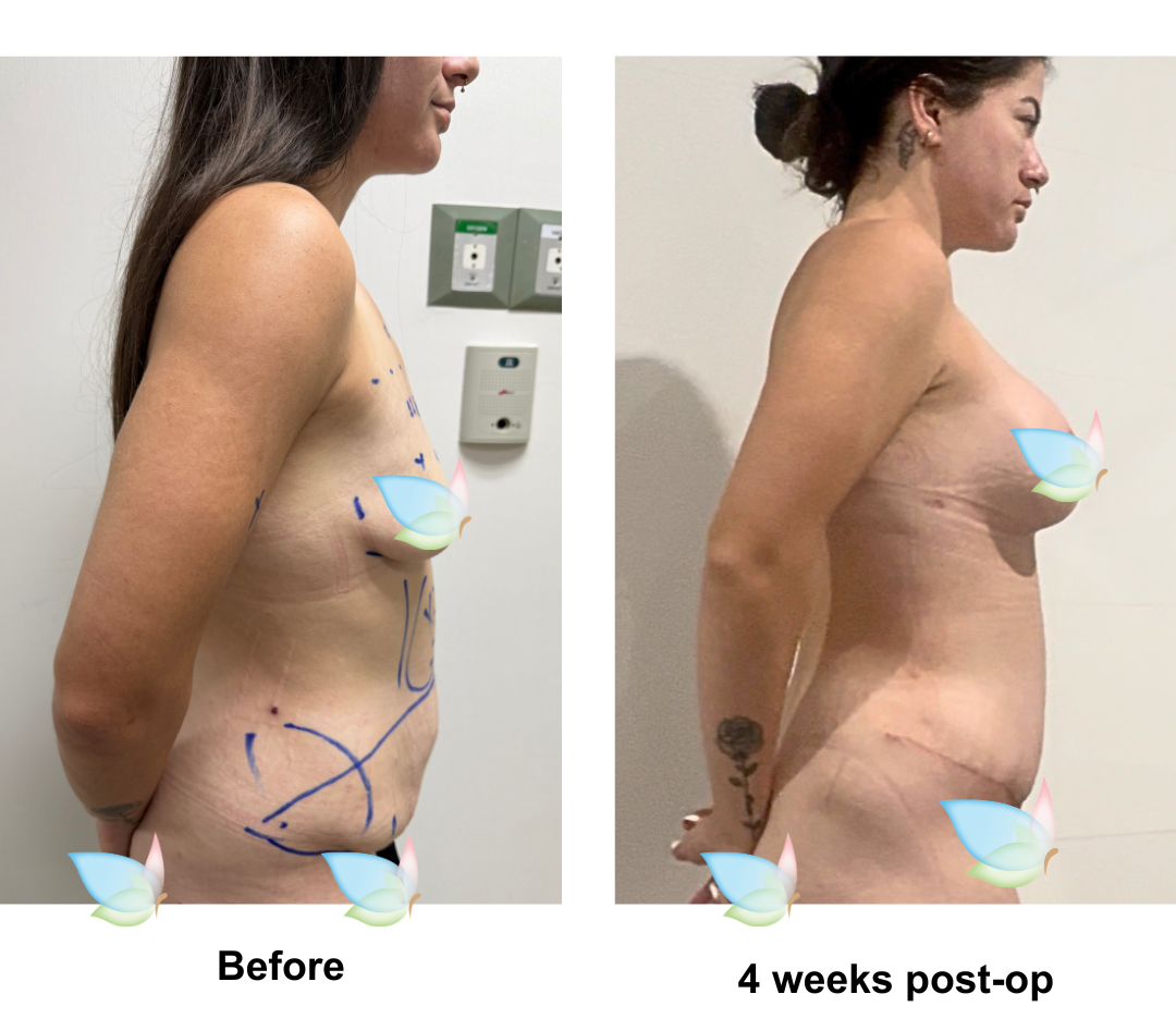 Teegan had BABL + ExTT + Lipo x2 + ML with Dr. Kasemsak (1)-1