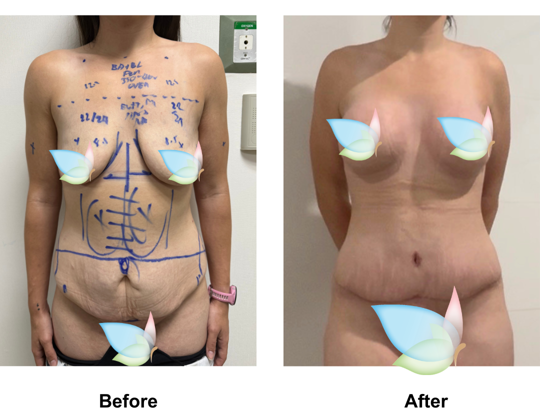 Teegan had BABL + ExTT + Lipo x2 + ML with Dr. Kasemsak (1)