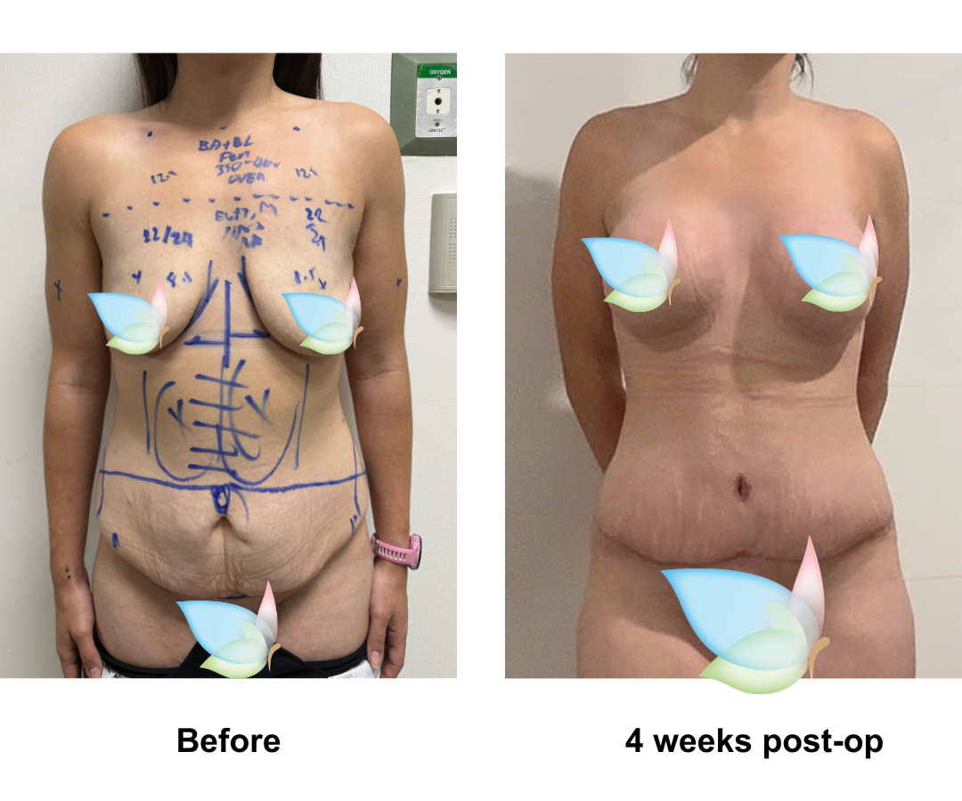 Teegan had BABL + ExTT + Lipo x2 + ML with Dr. Kasemsak-1
