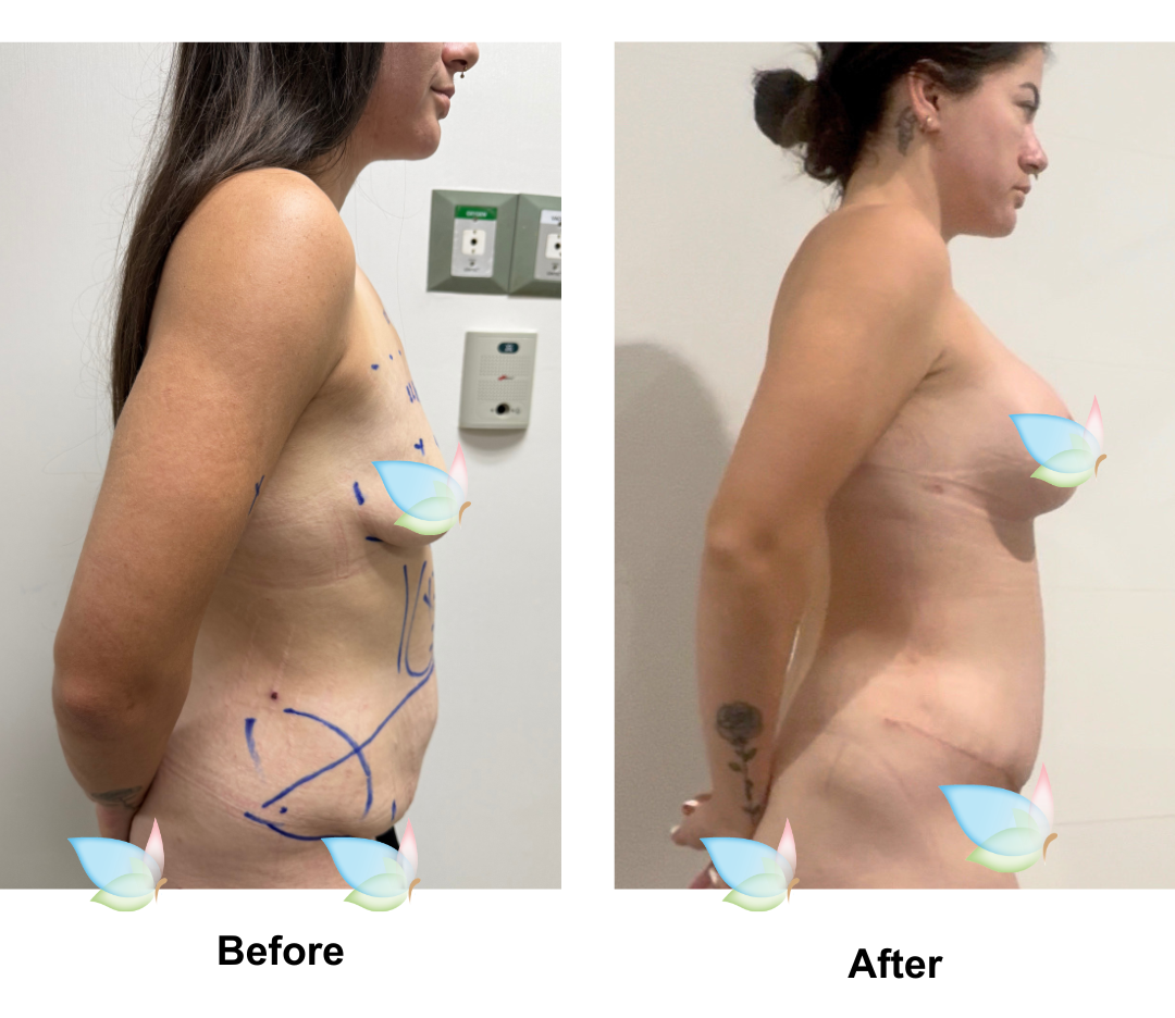 Teegan had BABL + ExTT + Lipo x2 + ML with Dr. Kasemsak