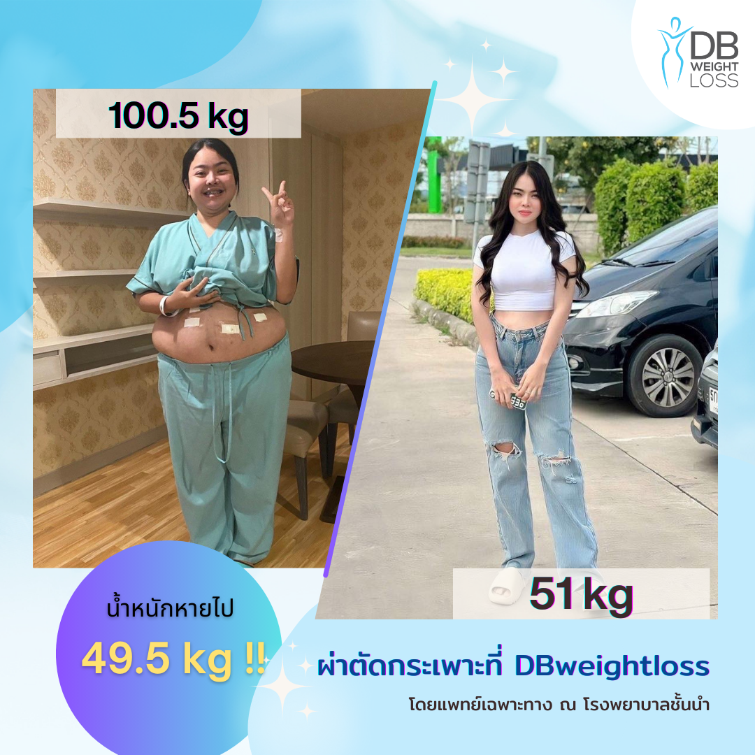 Thai patient weight loss surgery (2)