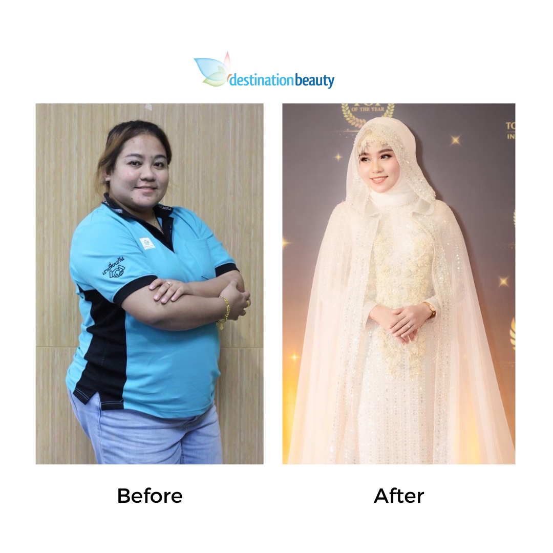 Thipparat had weight loss surgery (3)