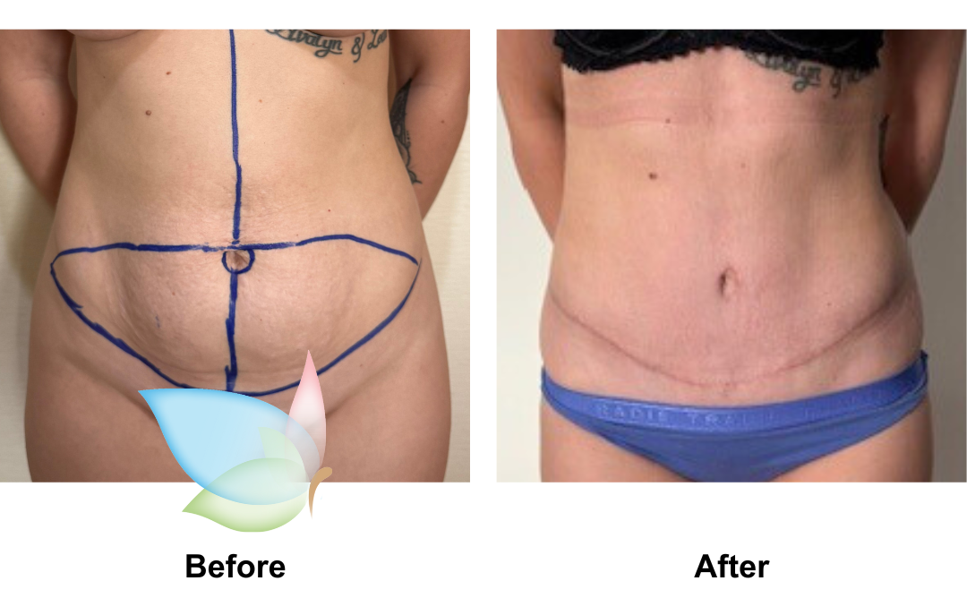 Tiana had Ex TT with Dr. Angkana (1)